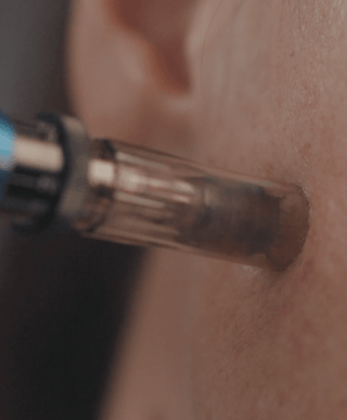 The microneedling facial to try this autumn - The Light Salon